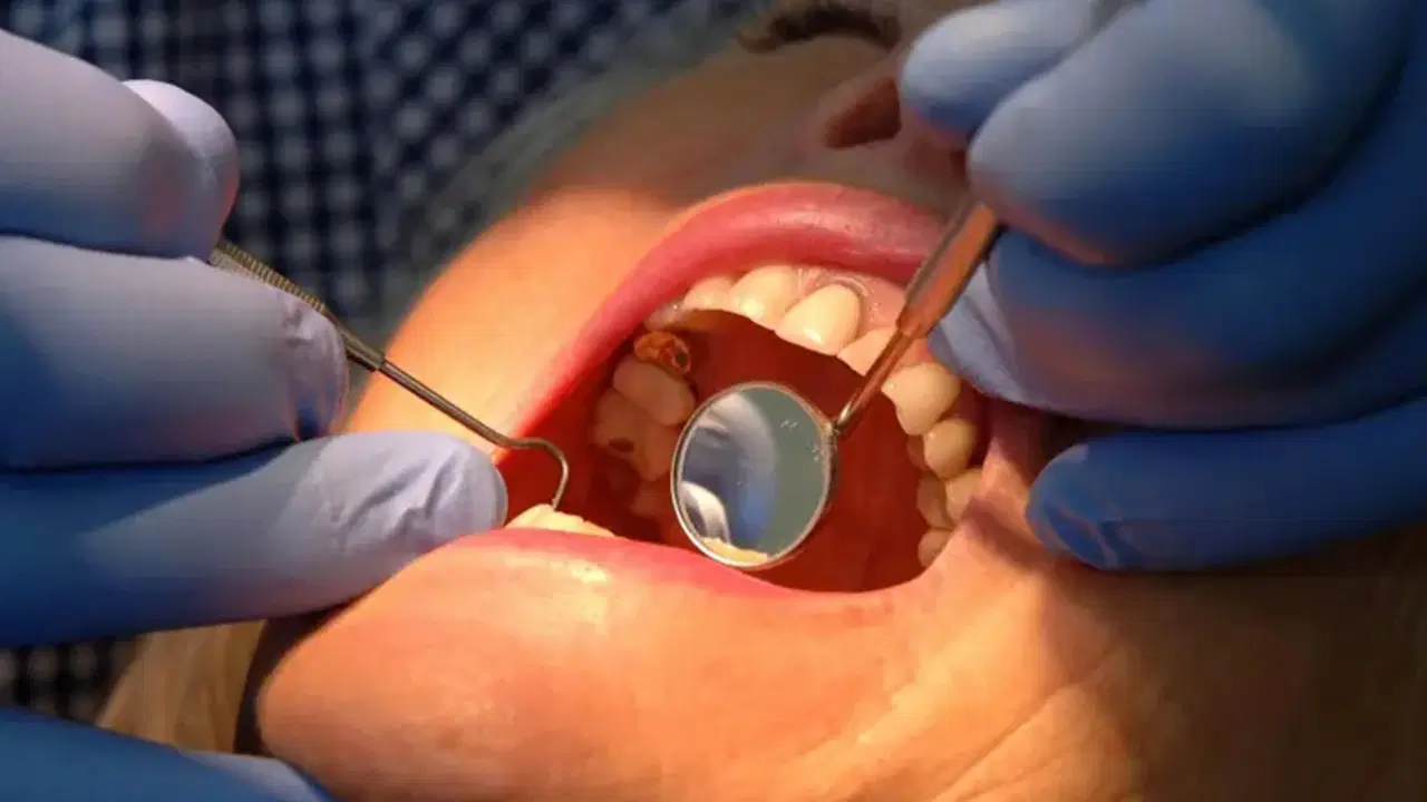 dis minesini onaran yeni jel curuklerin sonu mu geliyor JSC6K1WZ.jpg